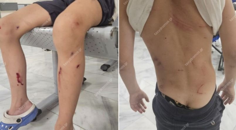 Βόλος: Στο νοσοκομείο 7χρονο αγόρι έπειτα από επίθεση αδέσποτων σκύλων – Τον δάγκωσαν στα πόδια και την πλάτη 